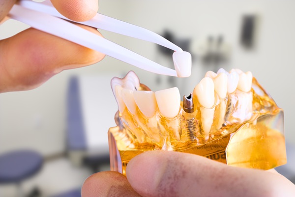 CEREC Crowns Compared To Other Restorations