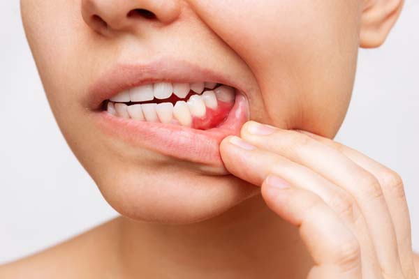 Gum Disease Draper, UT