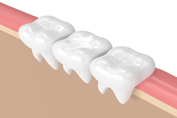 White Dental Fillings Draper, UT